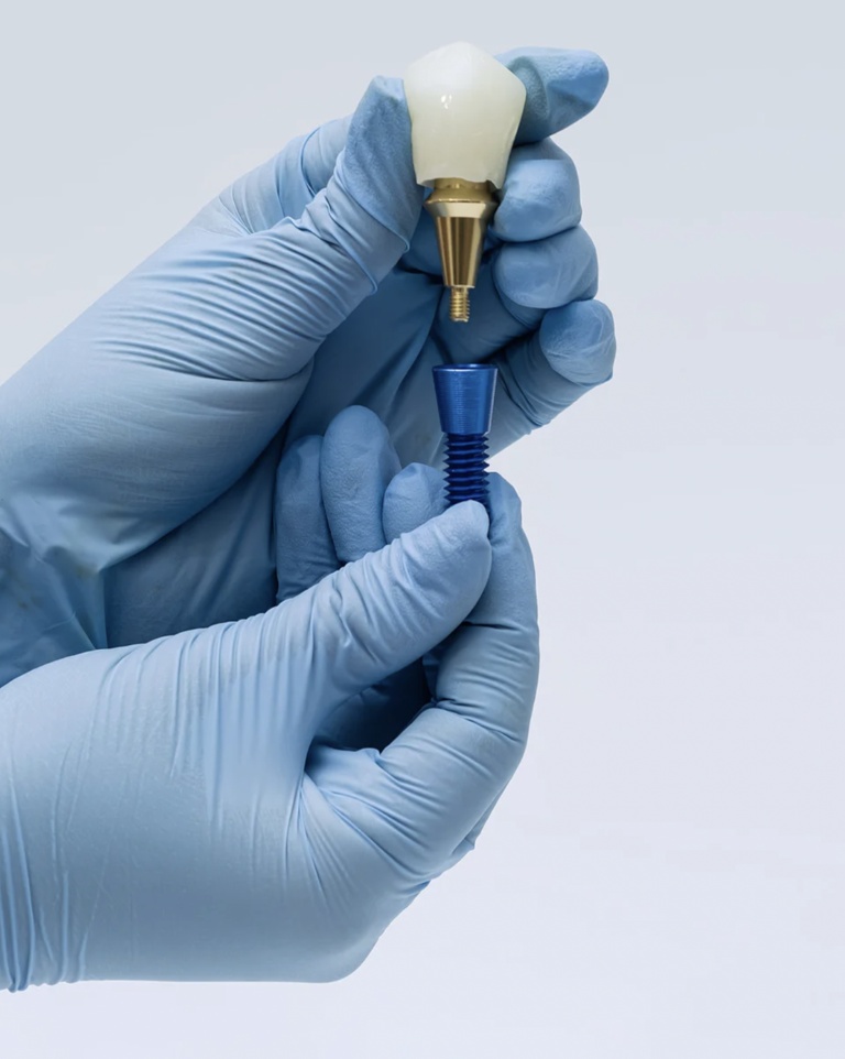 Couronnes sur implants