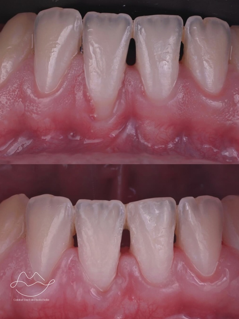 Récession gingivale